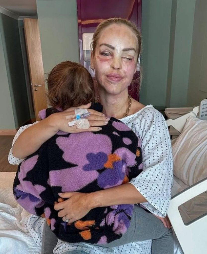 Katie Piper telah menjalani serangkaian operasi plastik akibat disiram air keras (Foto: Dok. Manchester Evening News)