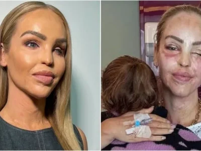 Perubahan wajah Katie Piper setelah disiram air keras. (Foto: Instagram/katiepiper_, Dok.Manchester Evening News)