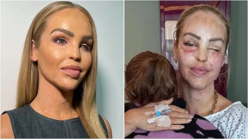 Setelah Disiram Air Keras, Katie Piper Tetap Bisa Menjadi Presenter TV