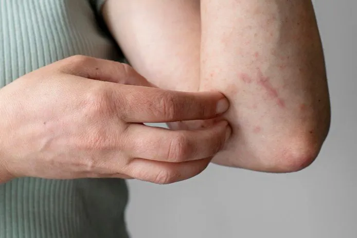 Pria Australia Idap Penyakit Langka Karena Kekurangan Vitamin C