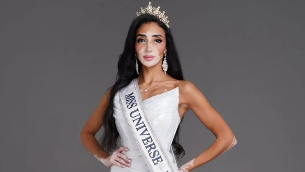 Logina Salah, Kontestan Pertama Miss Universe yang Idap Kelainan Kulit Langka