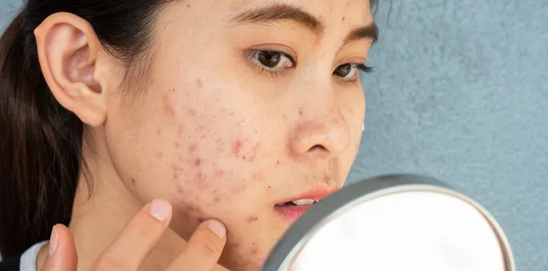 Bisa Picu Jerawat, Simak Cara Efektif Mengurangi Asupan Gula