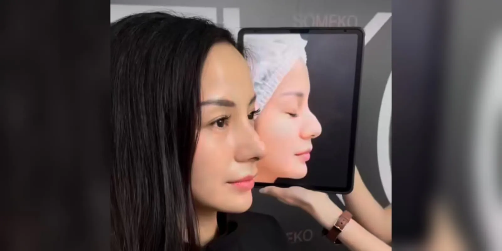 Hidung Bengkok, Kirana Larasati Oplas di Thailand