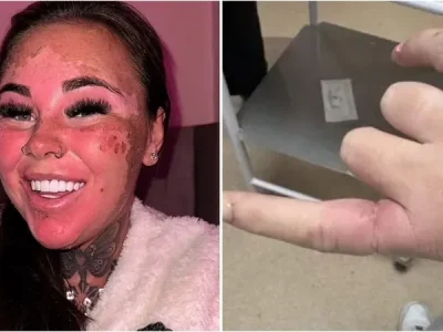 Kulit Natalia Armstrong terbakar setelah gunakan sunbed (Foto: Dok. Kennedy News and Media)