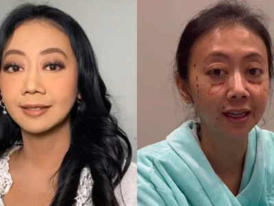 Asri Welas menjalani prosedur oplas di Korea Selatan. Foto: Dok. Kolase Instagram @fikaambarani, @nanahospital.id