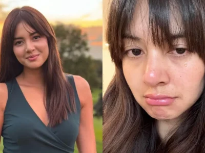 Aurelie Moeremans mengalami gegar otak akibat kecelakaan. Foto: Dok. Instagram @aurelie