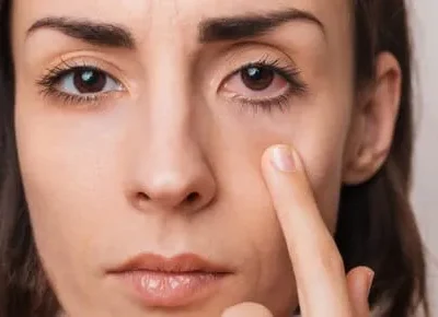 Ilustrasi penyakit mata retinopati diabetik. Foto: Dok. Freepik