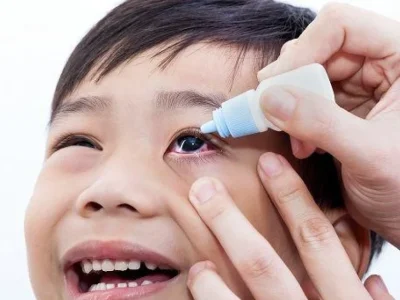 Ilustrasi mata merah, gejala serius yang bisa mengakibatkan uveitis. (Foto: Dok. Net)