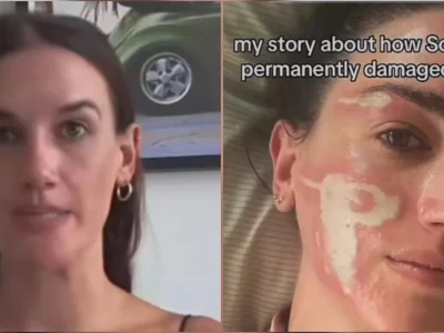 Wajah Victoria Nelson terbakar usai melakukan perawatan di Sonya Dakar Skin Clinic. (Foto: TikTok/Victoria Nelson)