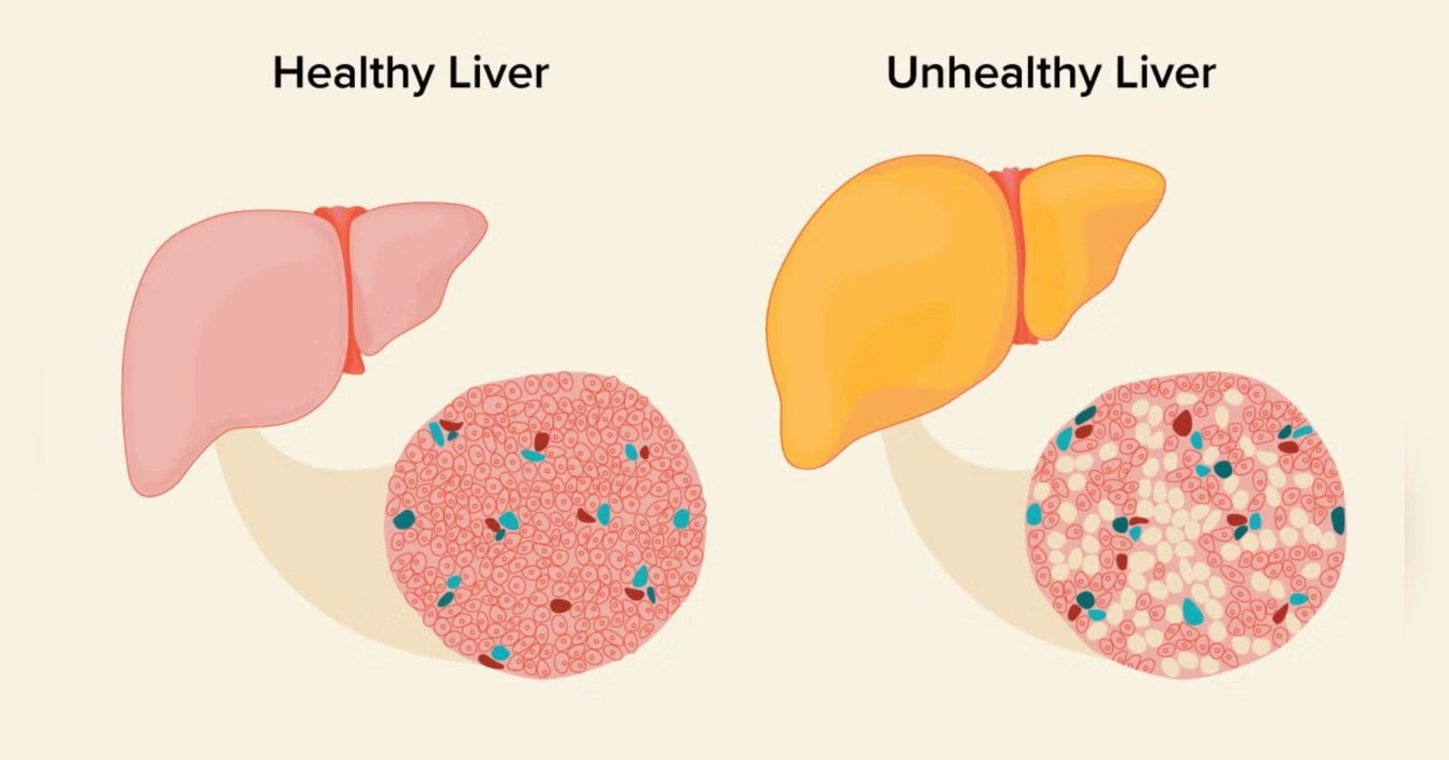 Diam-Diam Merusak dari Dalam, Cek Fatty Liver Sebelum Terlambat