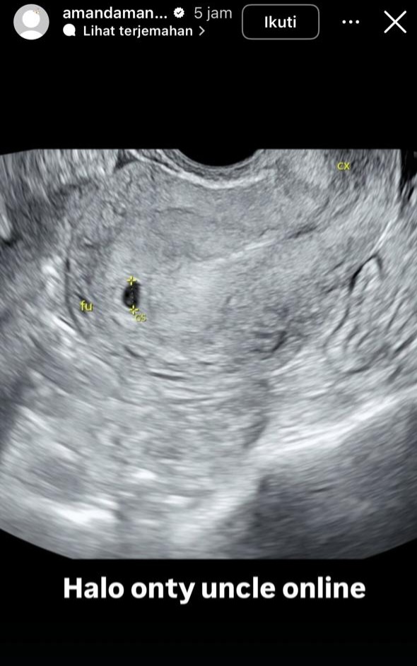 Hasil USG Amanda yang memperlihatkan kantung janin. Foto: Dok. Instagram @amandamanopo