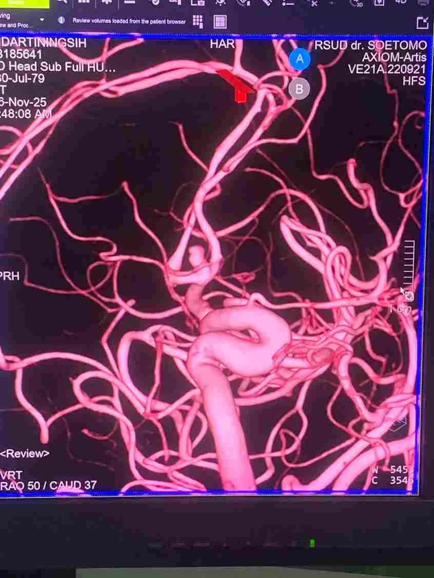 Gambar 3D pasien aneurisma otak. Foto : Dok Pri