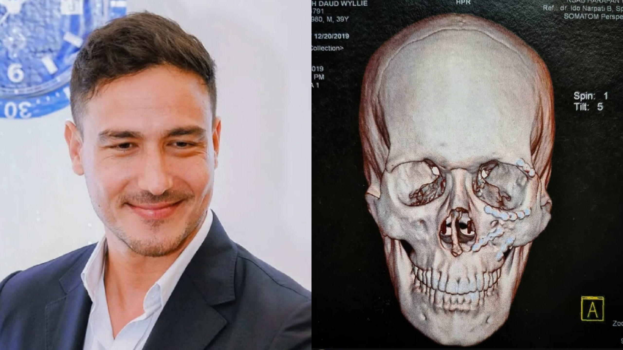 Wajah Hamish yang dipasangi banyak baut. Foto: Dok. Instagram @hamishdw