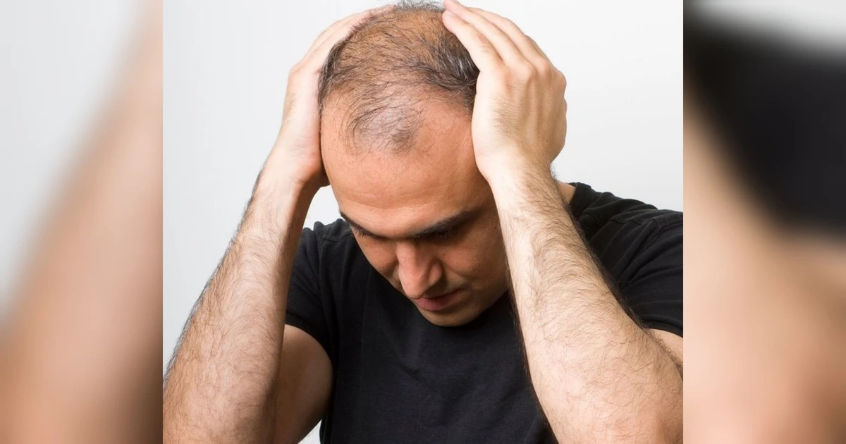 Botak Tengah yang Paling Sering Dialami Pria? Ini Penyebab dan Cara Mengatasinya
