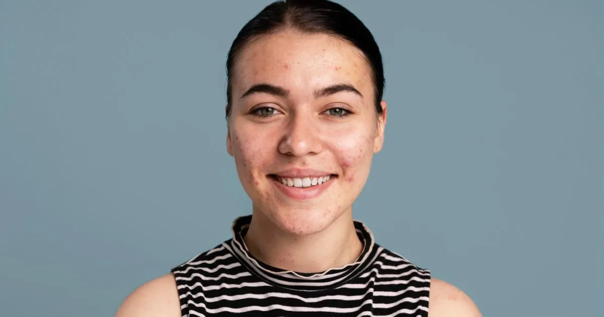 10 Cara Mengobati Jerawat Membandel, Ampuh untuk Semua Jenis Kulit