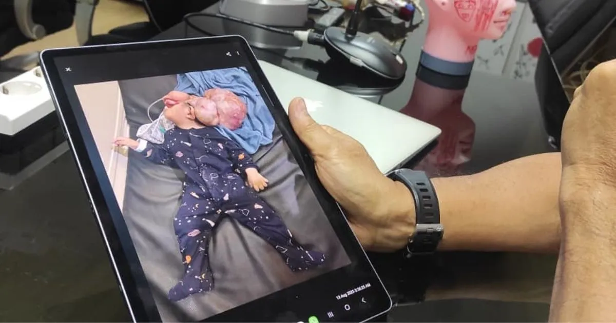 Kisah Balita Sulawesi Bertahan 2 Tahun tanpa Tempurung Kepala